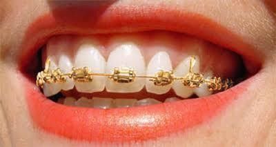 0.022/0.018 Tamanho da ranhura DTC Ortodontia Dental Brackets Revestidos de Ouro Brace Ortho Fabric