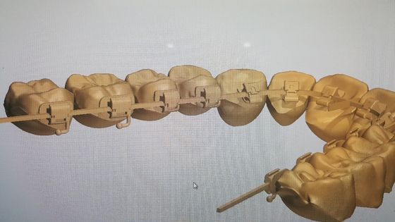 Máquinas poderosas Fonte DTC Ortodontia Braces Lingual com Brackets Auto-ligantes