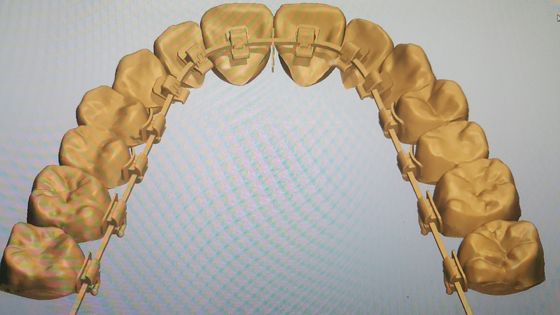 Máquinas poderosas Fonte DTC Ortodontia Braces Lingual com Brackets Auto-ligantes